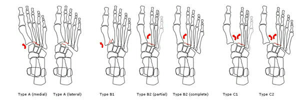 Lisfranc fracture classification2.jpg